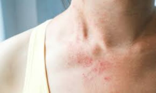 Skin diseases