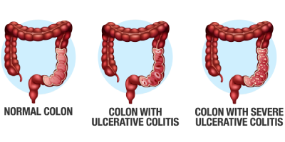 Ayurvedic treatment for ulcerative colitis