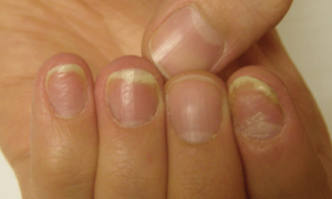 Psoriasis and Nail Pitting: Uncovering the Hidden Connection