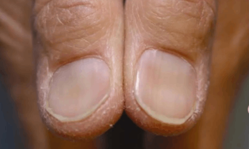 Spoon Nails (Koilonychia) - Identification, Causes & Treatment | Hurst  Podiatry