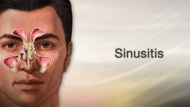 Sinusitis