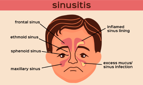 treatment sinusitis