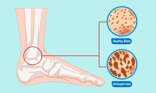 osteoporosis ayurveda