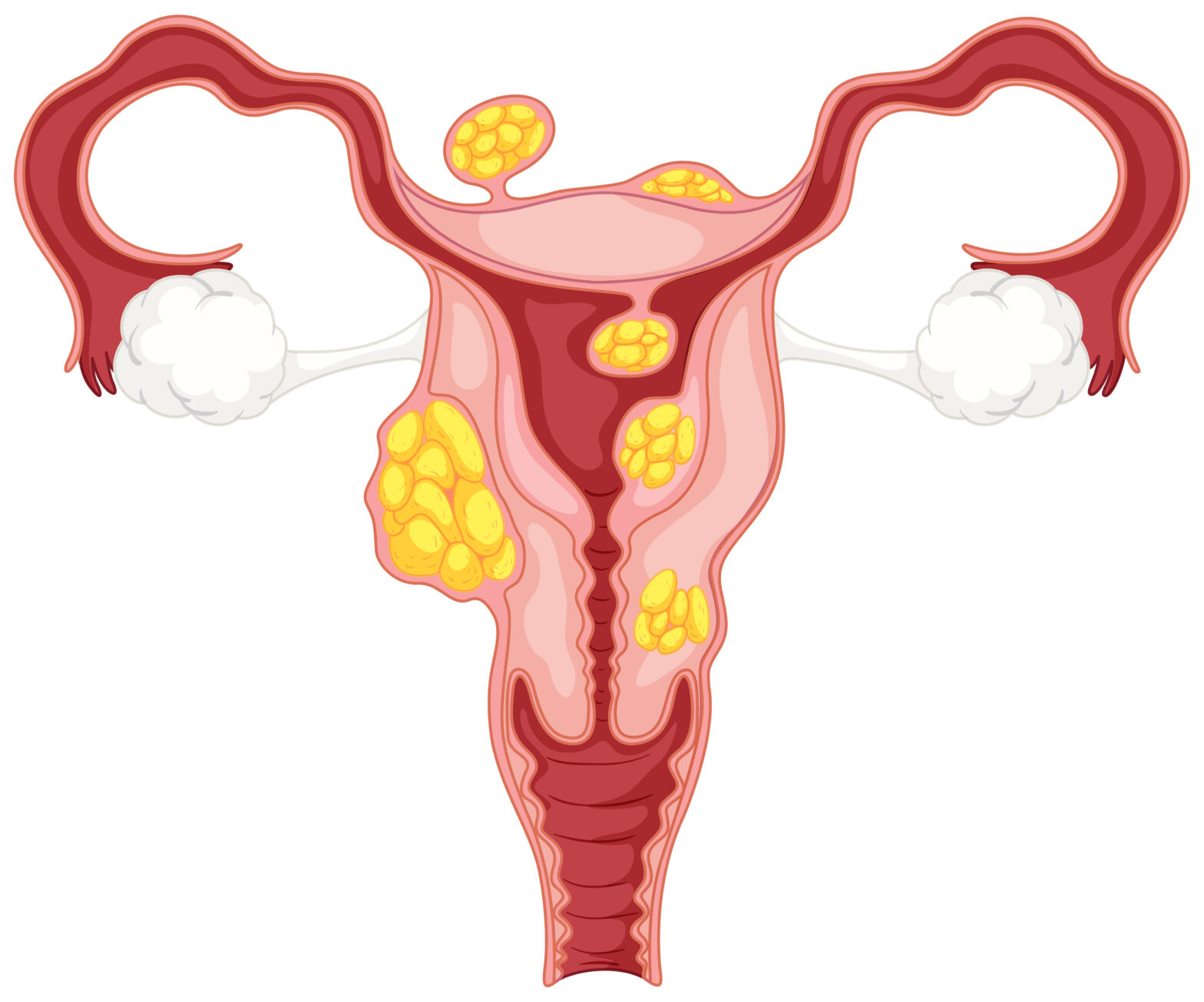 uterus-women-pcos