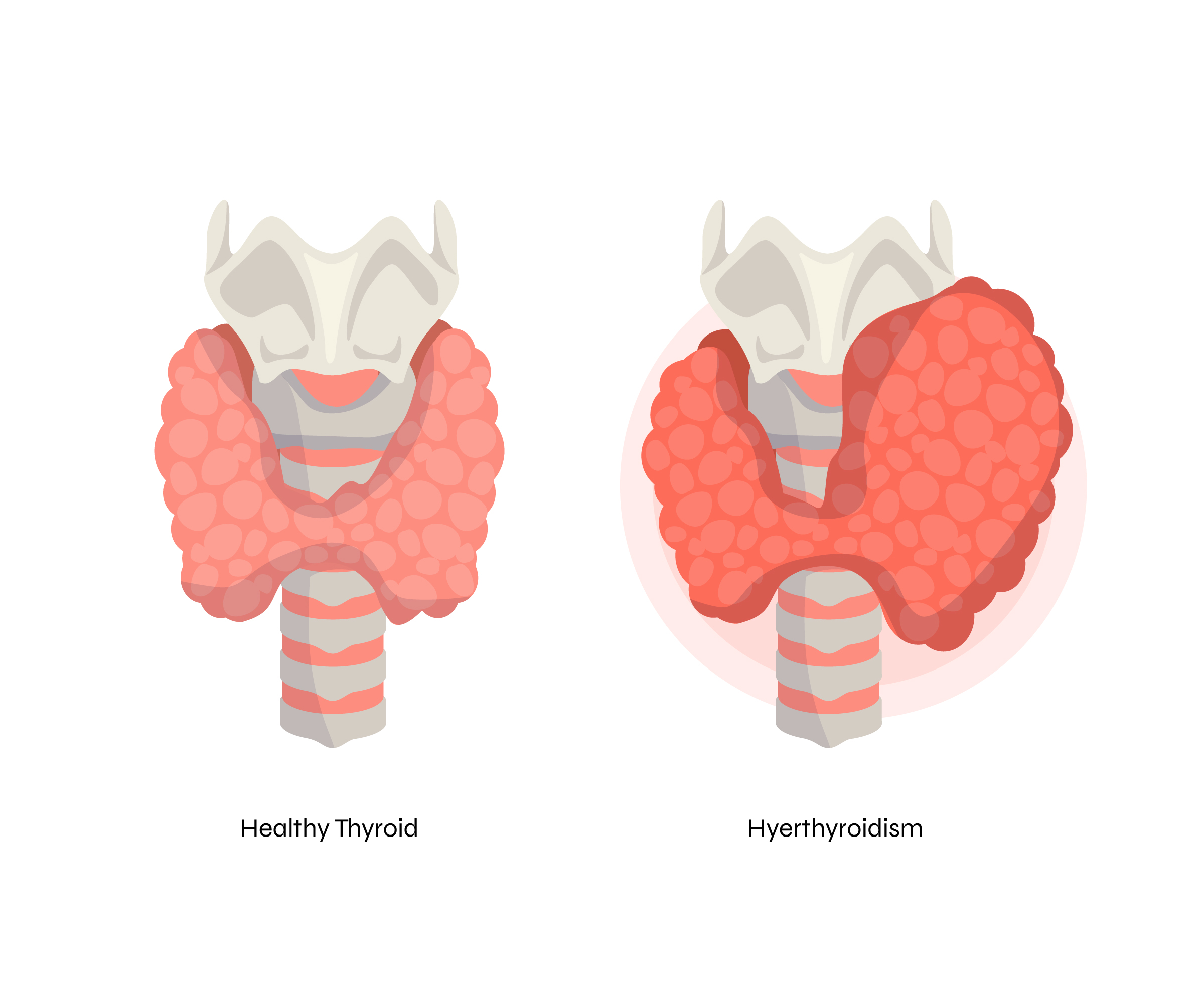 Hypothyroidism